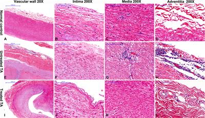 Potential Role of Macrophage Phenotypes and CCL2 in the Pathogenesis of Takayasu Arteritis